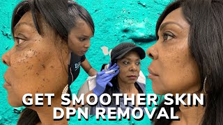 DPN removal for smoother skin [upl. by Tomkiel958]