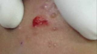 Treatment of Molluscum Contagiosumwmv [upl. by Eednar]