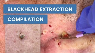 Extraction Satisfaction Blackhead Removal  CONTOUR DERMATOLOGY [upl. by Ecyrb406]