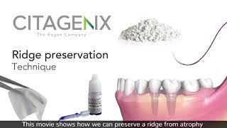 Ridge Preservation Bone Graft Technique Using Dental Products  Citagenix [upl. by Ainaled]