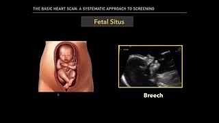 The Basic Fetal Heart Scan [upl. by Nnaeitak]