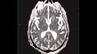 Cryptococcal meningitis [upl. by Ahsitram]