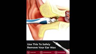 Tvidler The Safest way to remove earwax [upl. by Hilario]