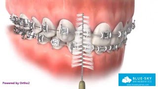 Oral Hygiene with Braces [upl. by Ahsika]