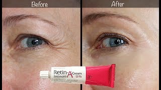 5Year RetinA Update  Before amp After for Wrinkles amp AntiAging [upl. by Ajiak]