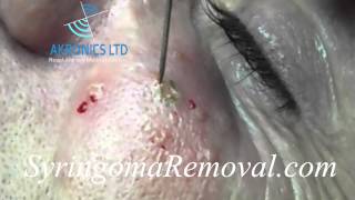 Syringoma Removal using ElectroFulguration [upl. by Ranson688]