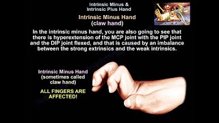 Intrinsic Minus amp Intrisic Plus Hand  Everything You Need To Know  Dr Nabil Ebraheim [upl. by Kort]