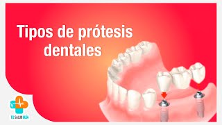 Tipos de prótesis dentales  Tu Salud Guía [upl. by Paulita799]