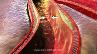 Assista a aula sobre Aterosclerose simulada na nova Lousa 3D Estereoscópico [upl. by Hedberg]