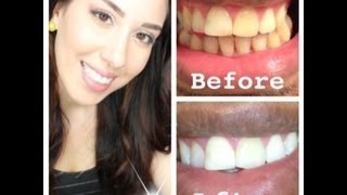 My At Home Teeth Whitening Routine WITH BEFORE AND AFTER PICTURES [upl. by Gigi239]