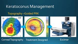 Full Thickness Corneal Transplantation Penetrating Keratoplasty PKP [upl. by Oshinski486]