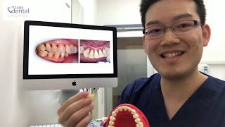 How to use interdental brush Piksters [upl. by Airamesor]