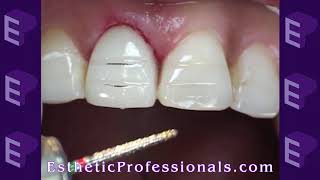 Porcelain Veneers Preparation Techniques 1 [upl. by Mathi458]