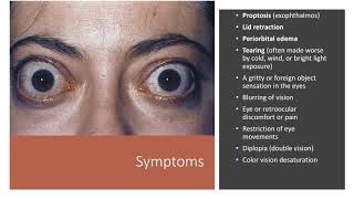 Thyroid Eye Disease [upl. by Leigh]