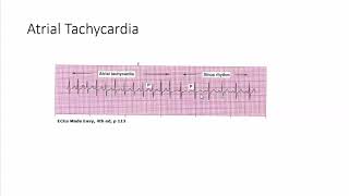 atrial tachycardia [upl. by Nylrats]