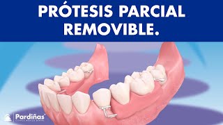 Prótesis parcial removible  ¿Cómo funcionan © [upl. by Omsoc]