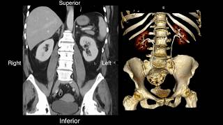 Normal Renal Anatomy [upl. by Irbua]