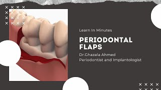 Periodontal Flaps [upl. by Andrei]