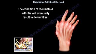 Rheumatoid Arthritis Of The Hand  Everything You Need To Know  Dr Nabil Ebraheim [upl. by Ahsienal]