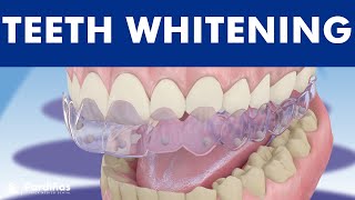 Teeth whitening  How is it done © [upl. by Sacci256]