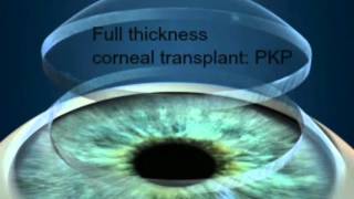 Corneal Transplant 2 Days After [upl. by Christos238]