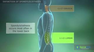 Spondylolisthesis Definition [upl. by Perce272]