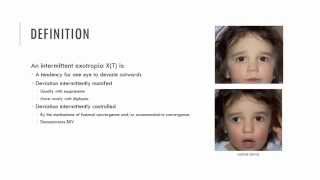 Intermittent Exotropia Characteristics [upl. by Mabel]