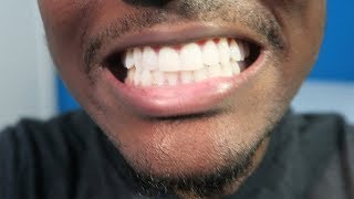 Crest 3D Whitestrips • 3 Months Later ReviewTips Whiten Your Teeth [upl. by Georgi28]