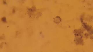 Blastocystis hominis  trophozoite [upl. by Dimphia]