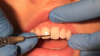 Periodontal Probing [upl. by Odel]