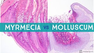 Molluscum vs Myrmecia Wart  Dermpath Lookalikes [upl. by Tarsus728]