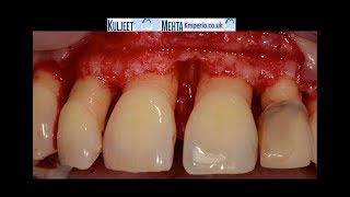 Periodontal Surgery Upper Front Teeth [upl. by Merrily]