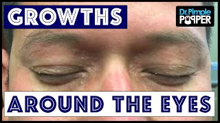 Removing Multiple Different Types of Growths around Eyes [upl. by Ellehctim]