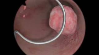 Endometrial Hyperplasia  CRASH Medical Review Series [upl. by Nwahsd770]