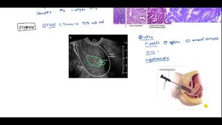 How is Endometrial Cancer Diagnosed [upl. by Willi]