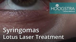 Syringomas  Lotus Laser Treatment 20245 [upl. by Oyek]