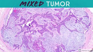 Chondroid Syringoma Mixed Tumor  Like Pleomorphic Adenoma of Skin 5Minute Pathology Pearls [upl. by Scoville]