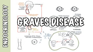 Graves Disease  Overview causes pathophysiology investigations and treatment [upl. by Arron]