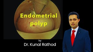 Myosure Polypectomy  Dr Kunal Rathod [upl. by Yelekalb]