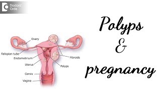 How are Endometrial Polyps diagnosed  Dr Shanthala Thuppanna [upl. by Goddard]