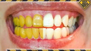 What Teeth Whitening Methods ACTUALLY Work [upl. by Annairb980]