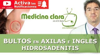 BULTOS en las AXILAS e INGLES  Golondrinos  Hidrosadenitis [upl. by Drwde]