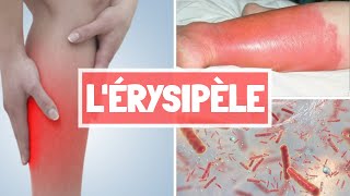 ÉRYSIPÈLE  CAUSES  SYPMTOMES  COMPLICATIONS  TRAITEMENT [upl. by Miah]