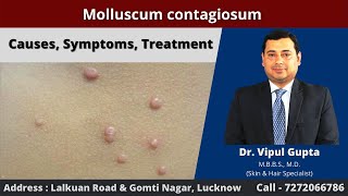 Molluscum contagiosum  Causes Symptoms Treatment [upl. by Yaf]