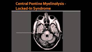 What is Periventricular White Matter [upl. by Ameen]