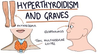 Understanding Hyperthyroidism and Graves Disease [upl. by Dranel]