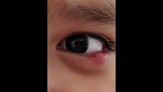 The biggest popping eye sty 2nd attempt [upl. by Dnalyr856]