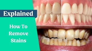 How to remove stains from the teeth [upl. by Enirolf]