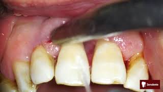 Advanced periodontal disease [upl. by Sivam]