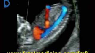 Fetal Medicine Foundation  Ductus venosus [upl. by Farlay]